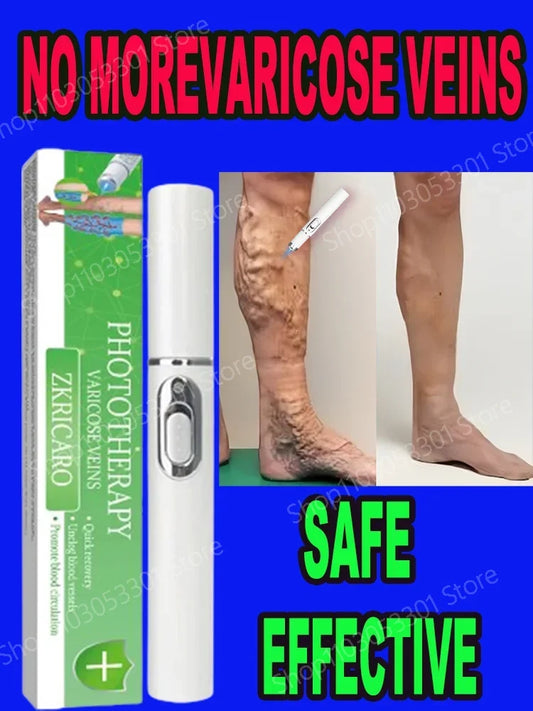 VenaWave™ Laser Therapy for Moderate Varicose Veins